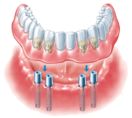 Behandlungsdauer bei Zahnimplantaten