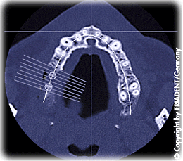 Mit einem Computertomogramm (CT) läßt sich die Höhe und Breite des Kiefers zuverlässig beurteilen und die exakte Lage der anatomischen Struktur wie Kieferhöhle oder Nervkanal darstellen