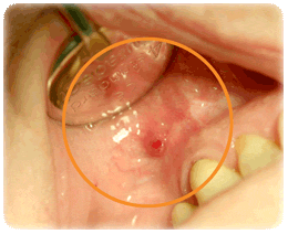 Die Zahnwurzelbehandlung