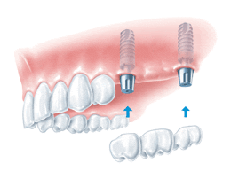 Erneuerung und Erweiterung des Zahnersatzes