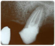 Endodontie Falldarstellung1