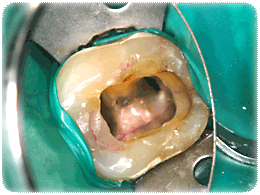 Zahnwurzelbehandlung : Behandlung eines frakturierten unteren Seitenzahnes Fallbeispiel 2 Dr. Langhanke und Kollegen
