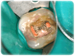 Zahnwurzelbehandlung : Behandlung eines frakturierten unteren Seitenzahnes Fallbeispiel 2 Dr. Langhanke und Kollegen