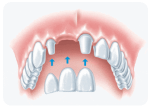 Implantologie als alternative zur Zahnwurzelbehandlung
