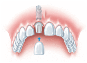 Implantologie als alternative zur Zahnwurzelbehandlung