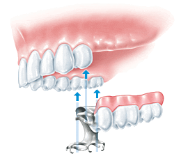Vorteile Implantat bei einseitig fehlenden Seitenzähnen