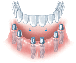 Vorteile Zahnimplantat bei Zahnlosigkeit