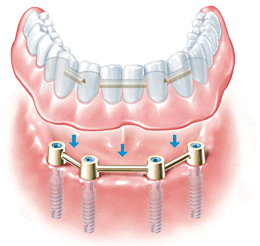 Vorteile Zahnimplantat bei Zahnlosigkeit