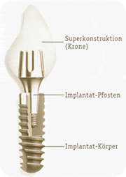 Was ist ein Implantat