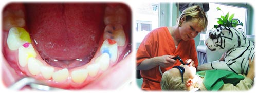 Kinder Zahnbehandlung